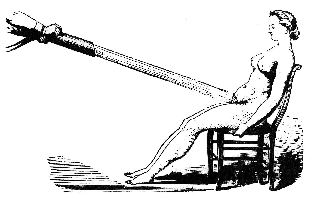 Duchas-vaginales-como-tratamiento-para-la-histeria.-Wikimedia-Commons