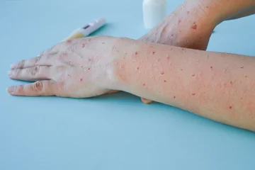 monkey-pox-virus-new-world-problem-of-modern-humanity-closeup-of-the-hands-of-sick-person-with-pimples-and-blisters