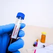 monkeypox-mpxv-blood-sample-in-test-tube-holding-by-doctor-hand