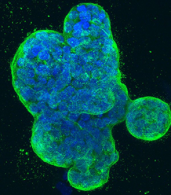p-human-breast-cancer-cells-kee